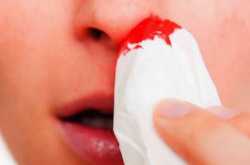 नाक से खून आने के कारण और नकसीर रोकने के 10 घरेलू उपाय