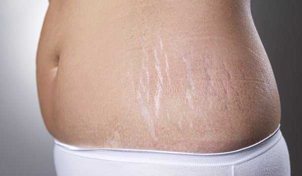 10 Home Remedies To Reduce Stretch Marks At Home After Pregnancy