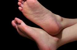 5 Amazing Natural Remedies to Cure Cracked Heels