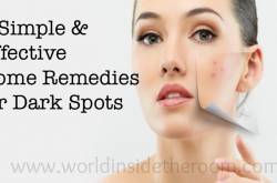 5 Simple & Effective Home Remedies for Dark Spots - WORLD INSIDE THE ROOM