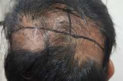 BODY HAIR TRANSPLANT:BODY HAIR AS DONOR