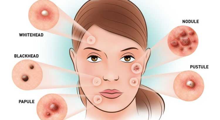 Battle Your Acne Problems With The Best Skin Specialist -