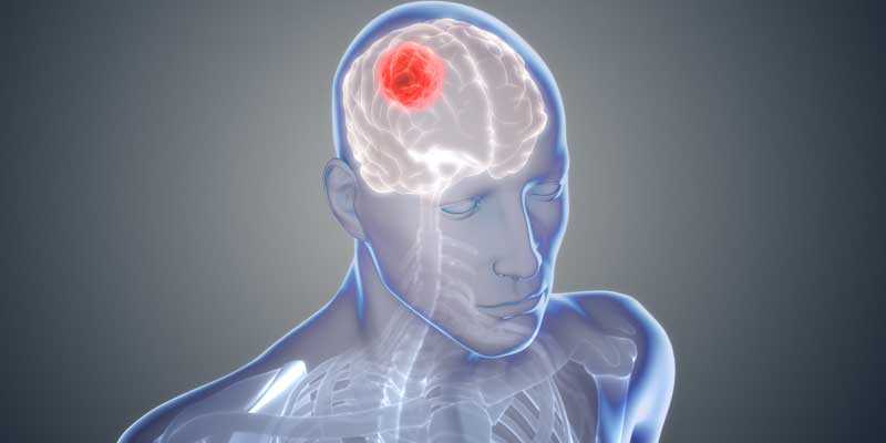 Brain Tumor | Brain Tumor Symptoms | Brain Tumor Treatment - Urdumania