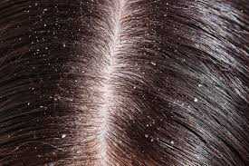 Dandruff - Home Remedies