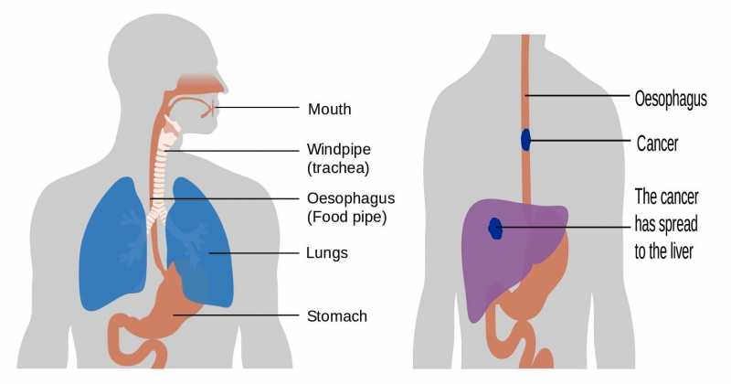 Detail Guide On Esophageal Cancer: Symptoms, Causes, And Preventions