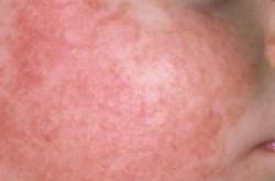 Fed up with those red chapped cheeks of your baby?