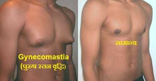 Gynecomastia (à¤ªà¥à¤°à¥à¤· à¤¸à¥à¤¤à¤¨ à¤µà¥à¤¦à¥à¤§à¤¿) à¤à¤¾ à¤à¤¾à¤°à¤£, à¤²à¤à¥à¤·à¤£ à¤à¤° à¤à¤ªà¤à¤¾à¤° 