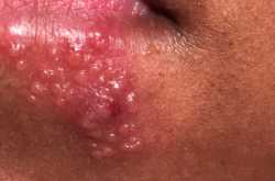 HERPES LABIALIS: COLD SORE, FEVER BLISTER ,TESTs AND TREATMENT