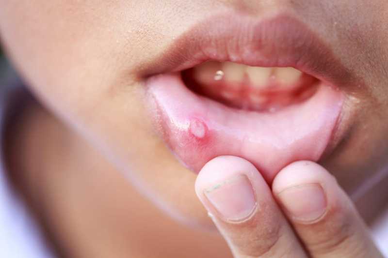 Home Remedies For Mouth Ulcers: Symptoms, Causes & Treatment