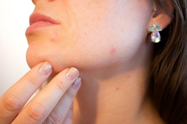 How To Get Rid Of Acne - 10 Natural Ways Eat Healthy, Stay Fit & Look Beautiful