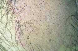 JOCK ITCH: Itching over groin(दाद ,खाज, खुजली) 