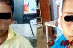 Melasma In Child Homeopathic Treatment