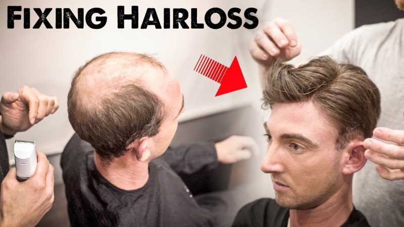 Mens Hairloss Treatment 2.0 | Amazing Hairstyle Transformation - Does It Work?