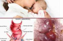 Obat Ambeien Setelah Melahirkan