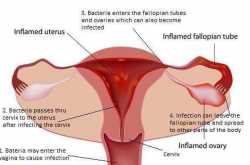 PID - Treat Pelvic Inflammatory Disease Naturally - Home Remedies Box