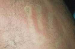 SKIN Manifestations in DENGUE FEVER 