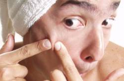 Should I pop my pimples? - Blackhead Skincare