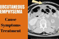 Subcutaneous emphysema: cause, symptoms and treatment - Gyan Share