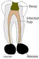 Tooth Absess
