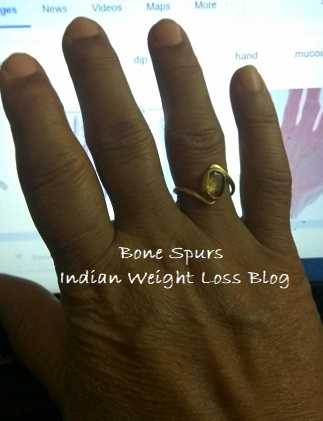 Weight Loss Tips When You Have Bone Spurs, Indian Weight Loss Blog