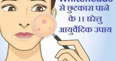 Whiteheads à¤¸à¥ à¤à¥à¤à¤à¤¾à¤°à¤¾ à¤ªà¤¾à¤¨à¥ à¤à¥ 11 à¤à¤°à¥à¤²à¥ à¤à¤¯à¥à¤°à¥à¤µà¥à¤¦à¤¿à¤ à¤à¤ªà¤¾à¤¯