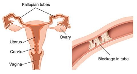 Wow! UnBlock Fallopian Tubes Naturally & Get Pregnant (Step By Step)