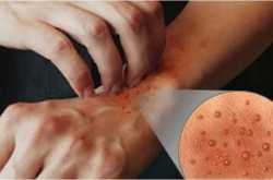 khujli ke upay with khujli home treatment खुजली के उपाय